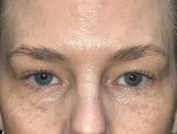 Lower Eyelid Blepharoplasty