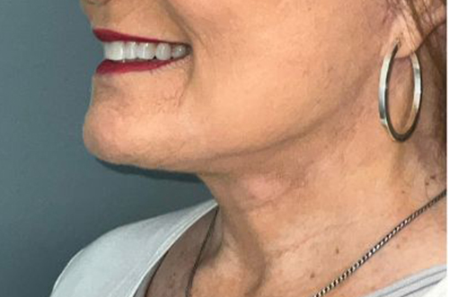 Facelift