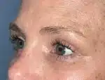 Lower Eyelid Blepharoplasty
