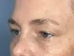 Lower Eyelid Blepharoplasty