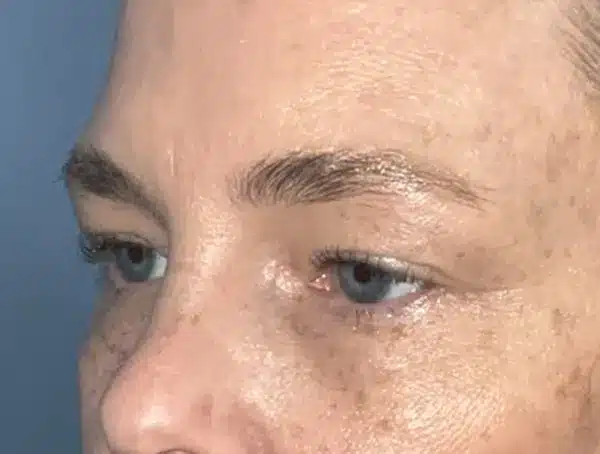 Lower Eyelid Blepharoplasty
