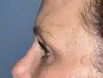 Lower Eyelid Blepharoplasty