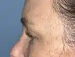 Lower Eyelid Blepharoplasty