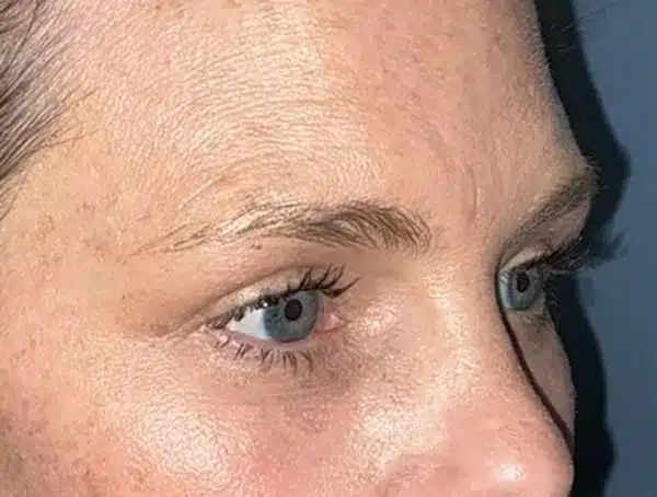 Lower Eyelid Blepharoplasty