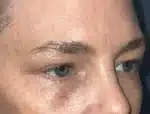 Lower Eyelid Blepharoplasty