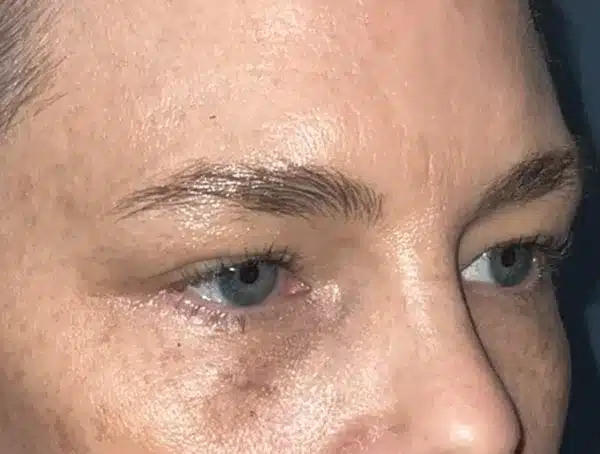 Lower Eyelid Blepharoplasty
