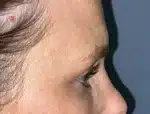 Lower Eyelid Blepharoplasty
