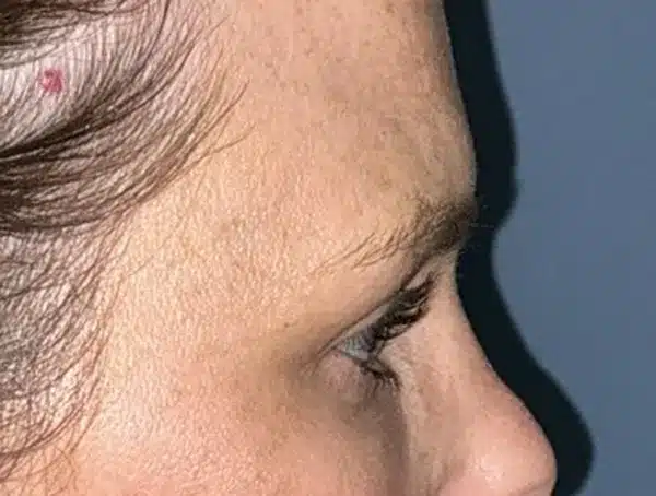 Lower Eyelid Blepharoplasty