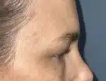 Lower Eyelid Blepharoplasty