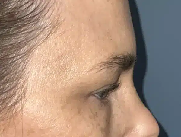 Lower Eyelid Blepharoplasty
