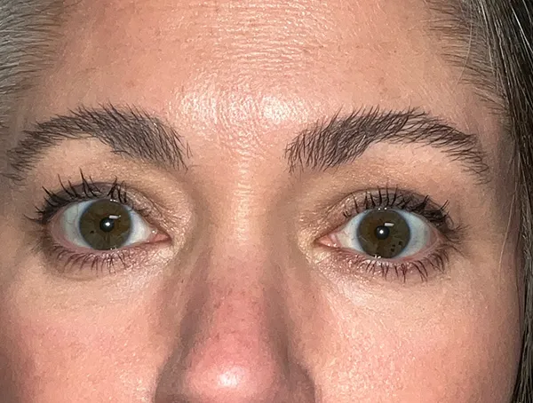 Lower Eyelid Blepharoplasty