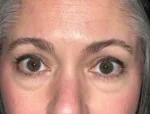 Lower Eyelid Blepharoplasty