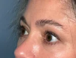 Lower Eyelid Blepharoplasty