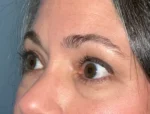 Lower Eyelid Blepharoplasty