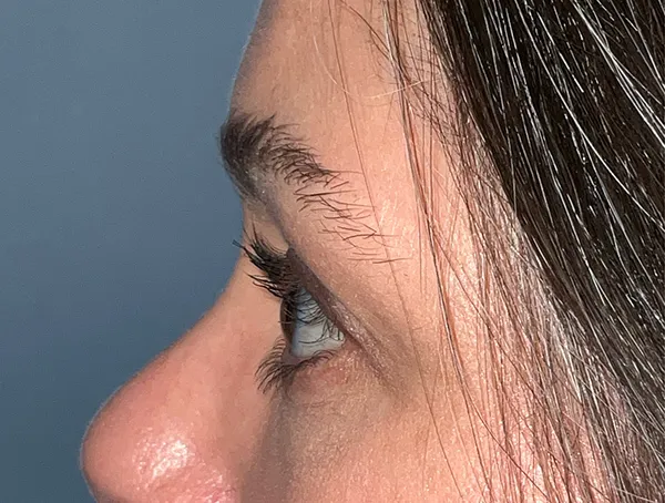 Lower Eyelid Blepharoplasty