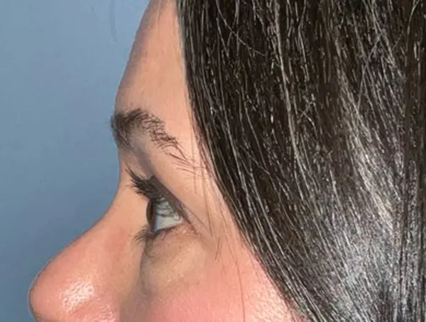 Lower Eyelid Blepharoplasty