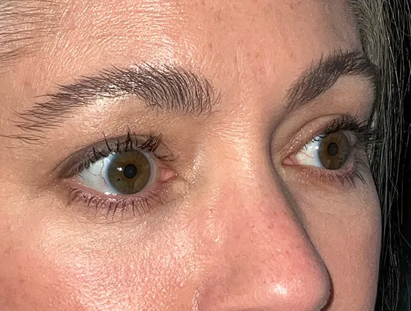 Lower Eyelid Blepharoplasty