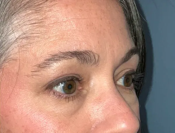 Lower Eyelid Blepharoplasty