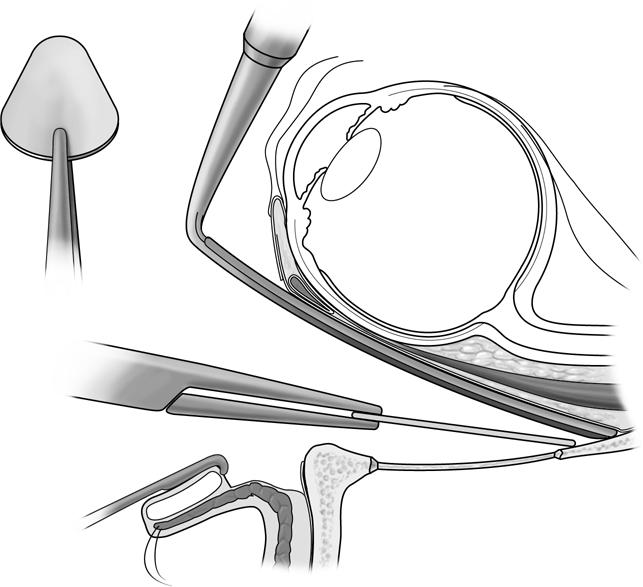 6ImplantPlacementBOF