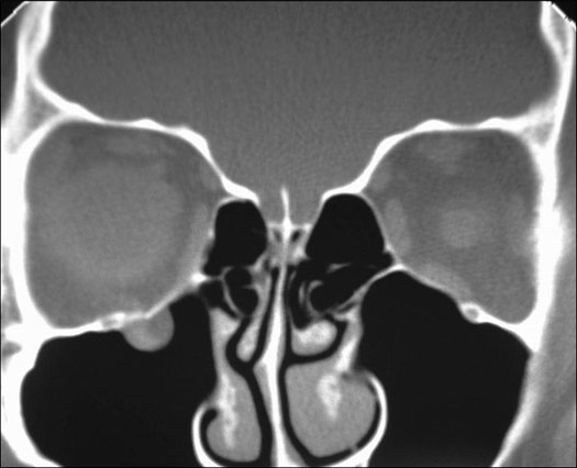 2RestrictedREyeSupraductionw_fracture