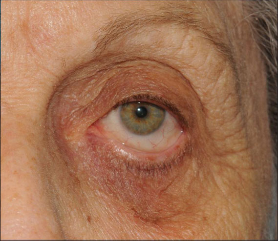 Ectropion Eyelid Surgery Little Rock Sagging Outward Eyelid Procedure