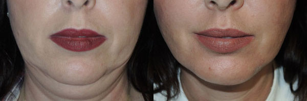 Before & After Facelift