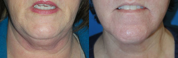 Before & After Facelift