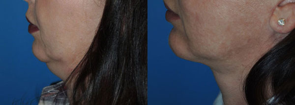 Facial Implants Gallery