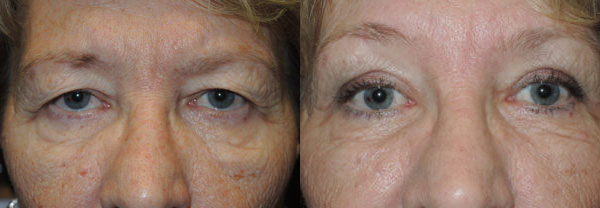 Functional Upper Eyelid Blepharoplasty - Before and After