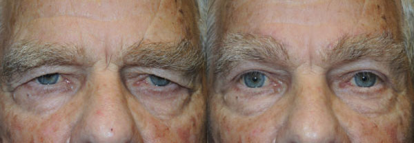 Functional Upper Eyelid Blepharoplasty - Before and After