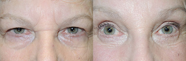 Brow Lift Before and After Little Rock