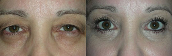 Brow Lift Before and After Little Rock