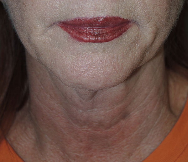 Mini Facelift Results Little Rock