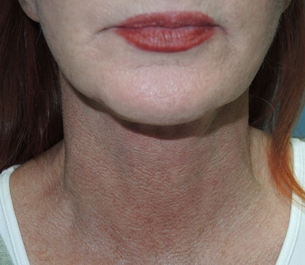 Mini Facelift Results Little Rock